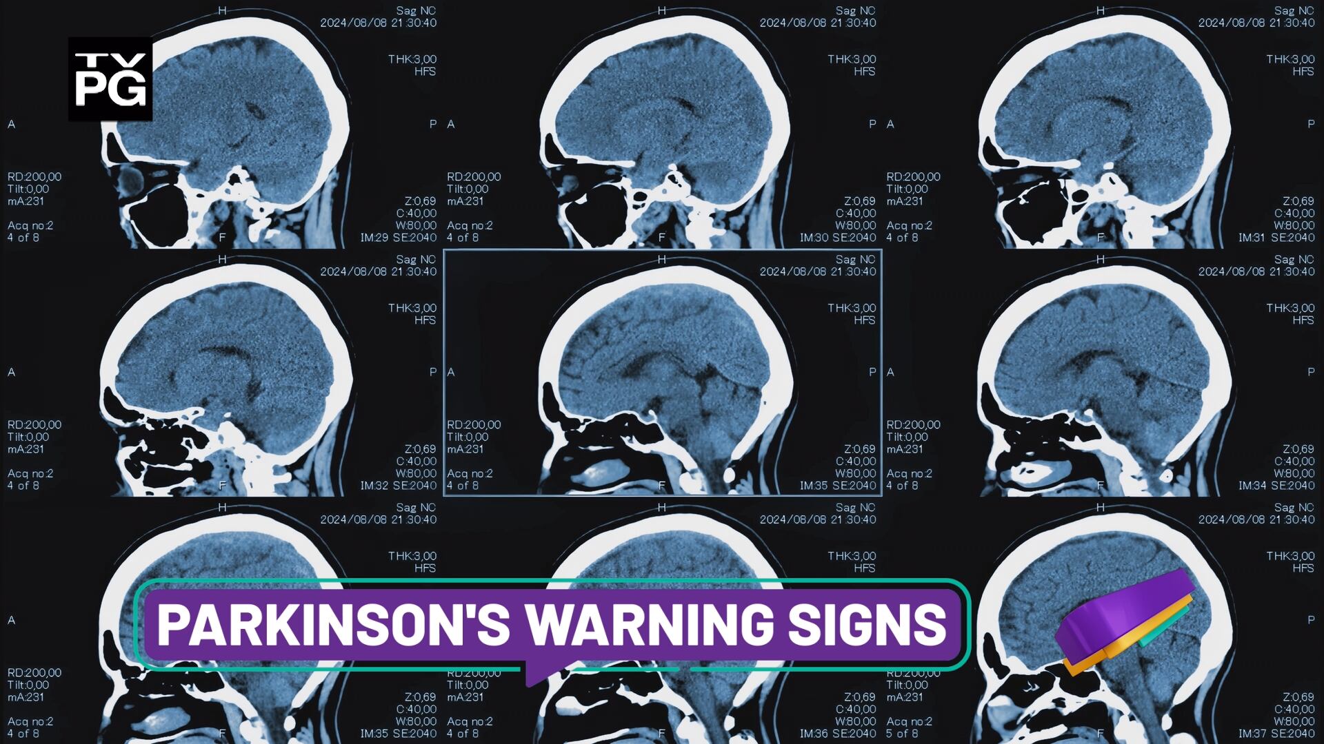 Parkinson's looks different in everyone and can start years before tremors show, with early signs like sleep issues or loss of smell.