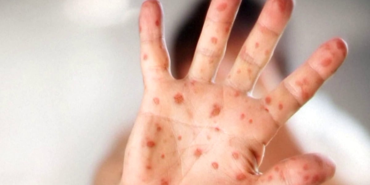 Measles case reported in North Carolina for first time in 2025: What to know