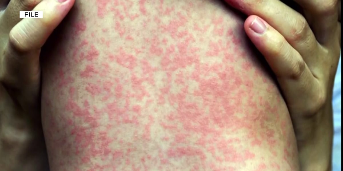 Measles reported in South Carolina for first time since 2024