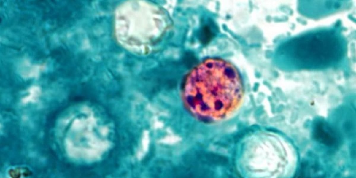1st case of cyclosporiasis confirmed in Rowan County: What to know