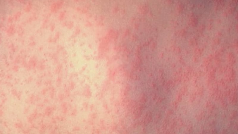 Seventeen new cases of measles were confirmed in South Carolina on Friday, state health...